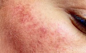 A skin rash caused by endometriosis on a patient's face