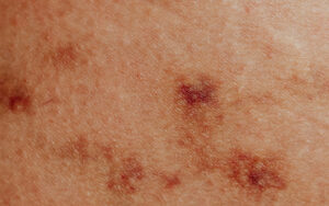 Skin flare ups from Endometriosis